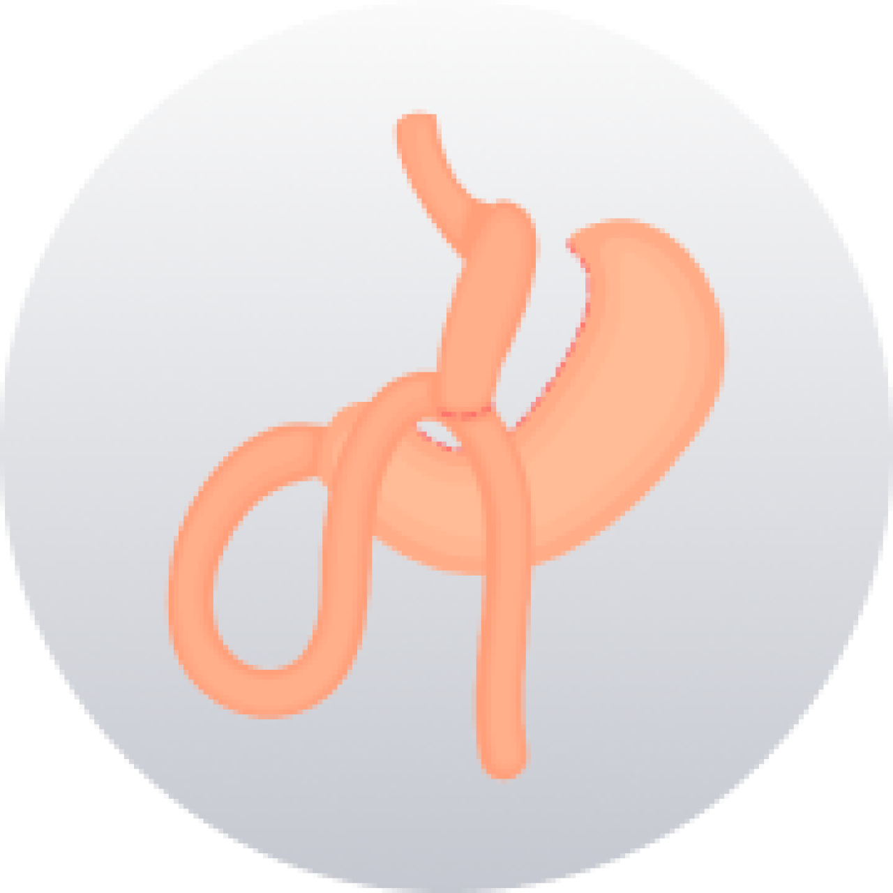 Mini Gastric.