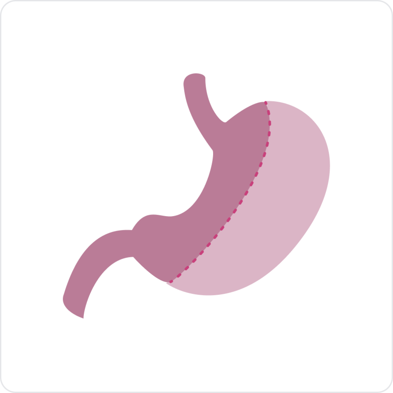 Laparoscopic Sleeve Gastrectomy.