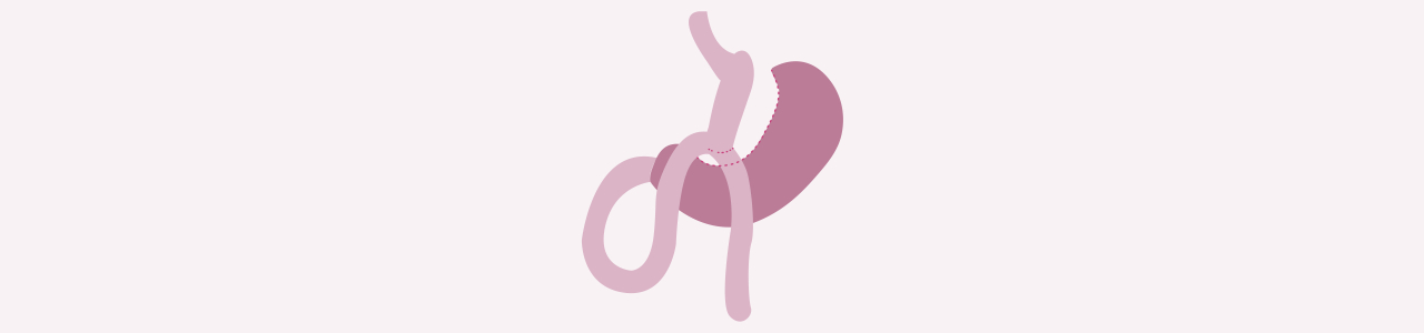 Mini Gastric.