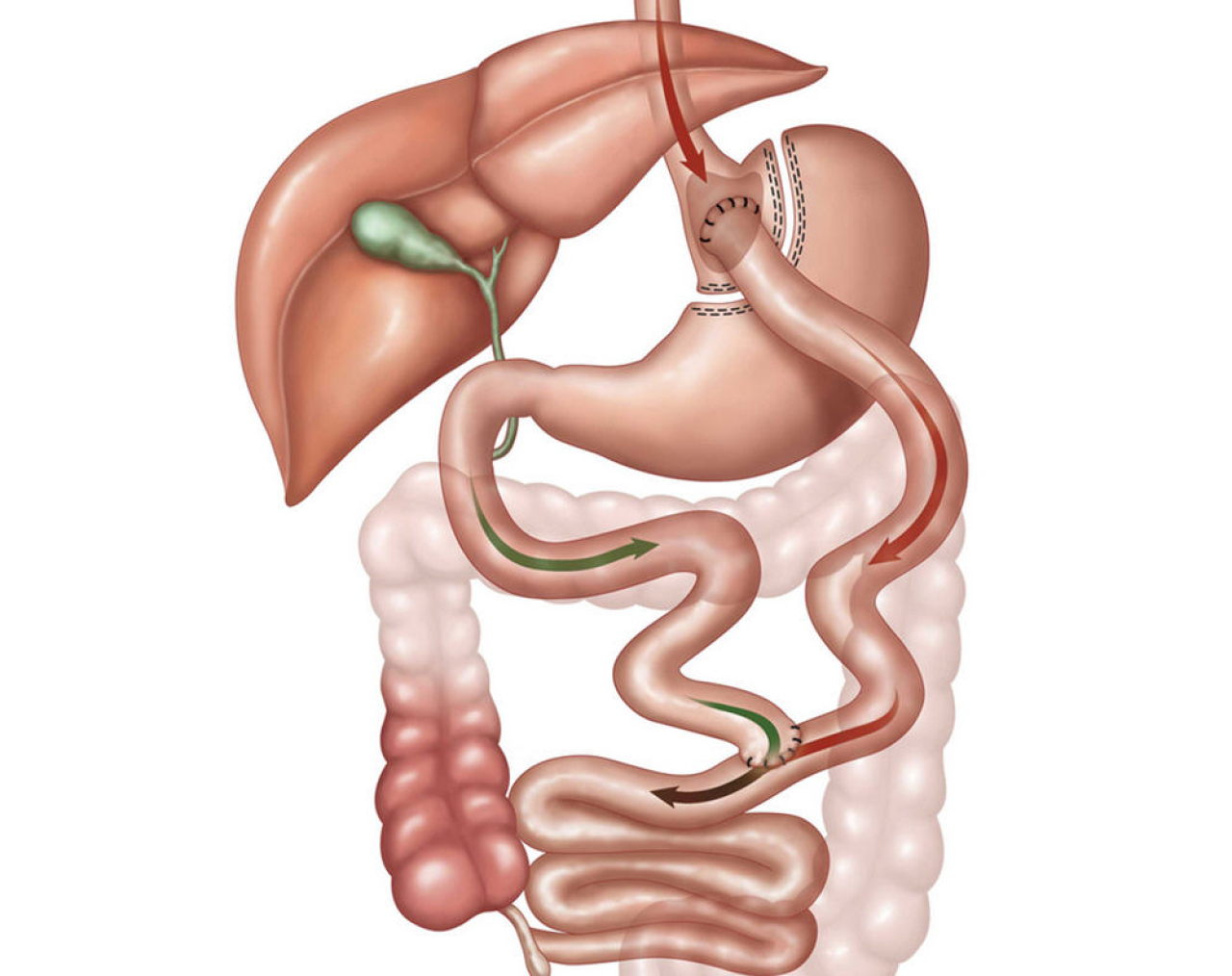 Bariatric Surgery.