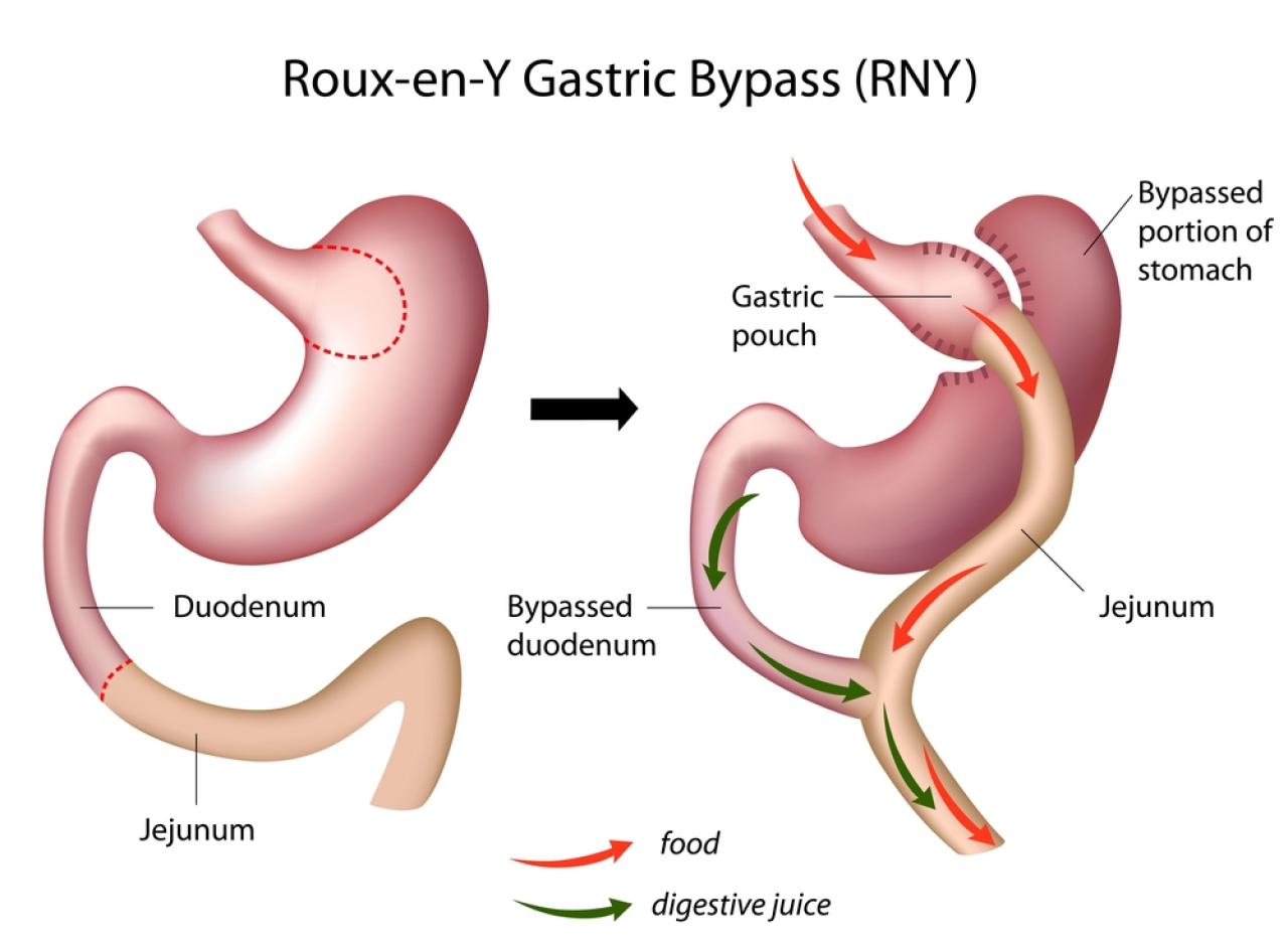 Rnygastric Bypass.